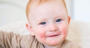 Врската помеѓу атопичен дерматитис и храна