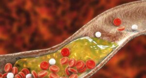 3 едноставни чекори за природно намалување на холестеролот: Ова е најдобриот начин за чистење на крвните садови