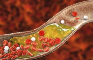 3 едноставни чекори за природно намалување на холестеролот: Ова е најдобриот начин за чистење на крвните садови