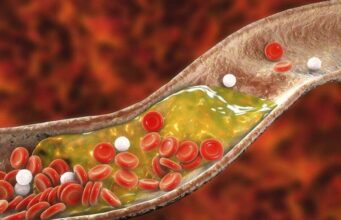 3 едноставни чекори за природно намалување на холестеролот: Ова е најдобриот начин за чистење на крвните садови