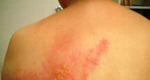 Херпес зостер – симптоми и третман