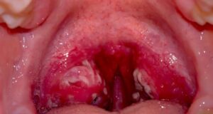 Гнојна ангина – болно воспаление на грлото кое се лекува со антибиотици