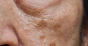 На лицето на заболениот може да се забележи првиот симптом на ЗАМАСЕН ЦРН ДРОБ – Потењето и лошиот здив најлесно се препознаваат, но многумина ги игнорираат овие СИГНАЛИ на телото