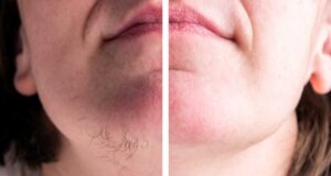 Природна маска која засекогаш ги отстранува несаканите влакна на лицето