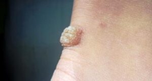 ЖОЛТИОТ СОК ОД ОВА ЛЕКОВИТНО РАСТЕНИЈА ПОМАГА ЗА брадавиците Го користеле дури и старите Римјани, а растворот може да трае и половина година