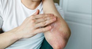 Псоријаза на лактите: причини и методи на лекување