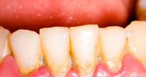 8 природни начини да се ослободите од забен камен