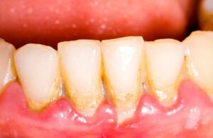 8 природни начини да се ослободите од забен камен