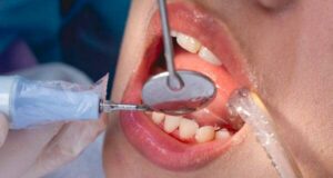 Колку често треба да се отстранува забен камен од забите?