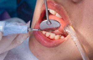 Колку често треба да се отстранува забен камен од забите?