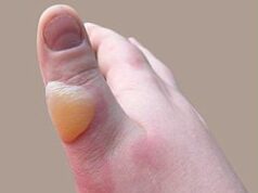 Што да се стави на изгореница?