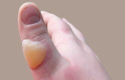 Што да се стави на изгореница?