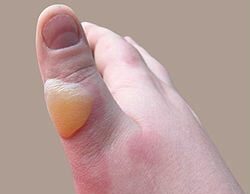 Што да се стави на изгореница?