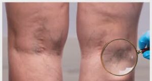 Венска болест – како се јавува и како се лекува?