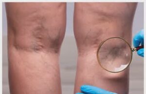 Венска болест – како се јавува и како се лекува?