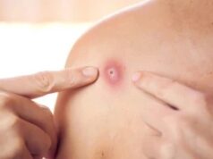 7 болести кои предизвикуваат грутки на телото: Ова се најчестите причини, не сите се причина за паника