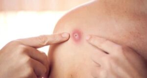 7 болести кои предизвикуваат грутки на телото: Ова се најчестите причини, не сите се причина за паника