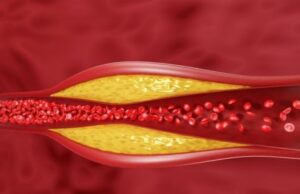 Тивок убиец во крвта: Кардиолозите тврдат дека 1 промена го чисти телото од лошиот холестерол