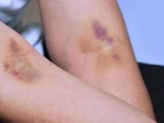 Ова се причините за модринки по земање крв: Знак дека треба веднаш да посетите лекар