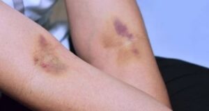 Ова се причините за модринки по земање крв: Знак дека треба веднаш да посетите лекар