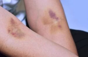 Ова се причините за модринки по земање крв: Знак дека треба веднаш да посетите лекар