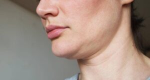 Природни начини за ублажување на брчките на вратот