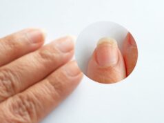 Овој знак укажува на рак: Промените на ноктите откриваат од што страдате