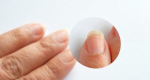 Овој знак укажува на рак: Промените на ноктите откриваат од што страдате