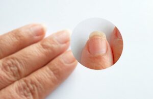 Овој знак укажува на рак: Промените на ноктите откриваат од што страдате