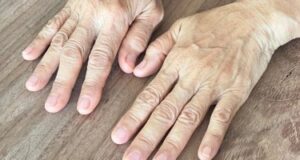 Знаци кои предупредуваат на лоша циркулација: Ја припишуваме на замор и стрес, а состојбата е многу посериозна