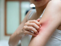 Убод од пчела, оса или комарец: кога реакцијата е нормална и кога е опасна