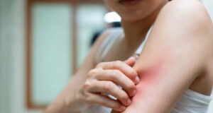 Убод од пчела, оса или комарец: кога реакцијата е нормална и кога е опасна