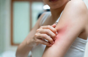 Убод од пчела, оса или комарец: кога реакцијата е нормална и кога е опасна